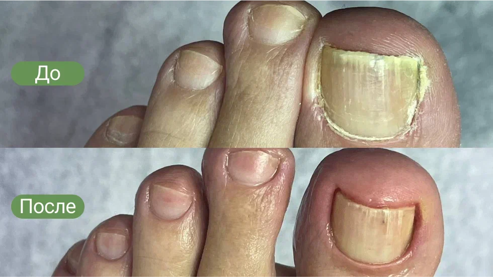 грибковое поражение