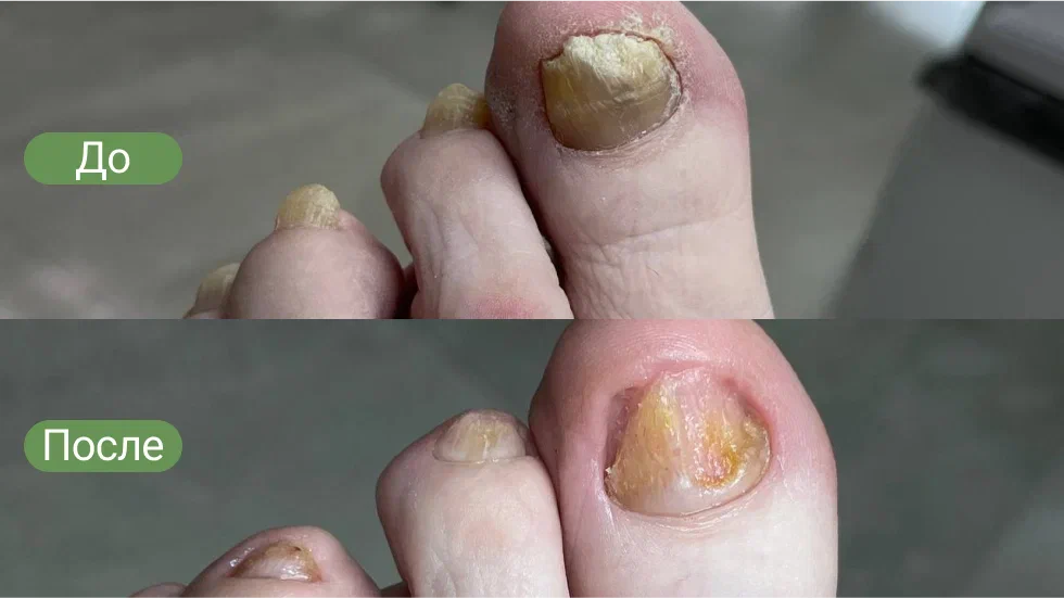 сахарный диабет